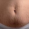 stretch marks post-pregnancy - Matritva Care