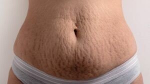 stretch marks post-pregnancy - Matritva Care