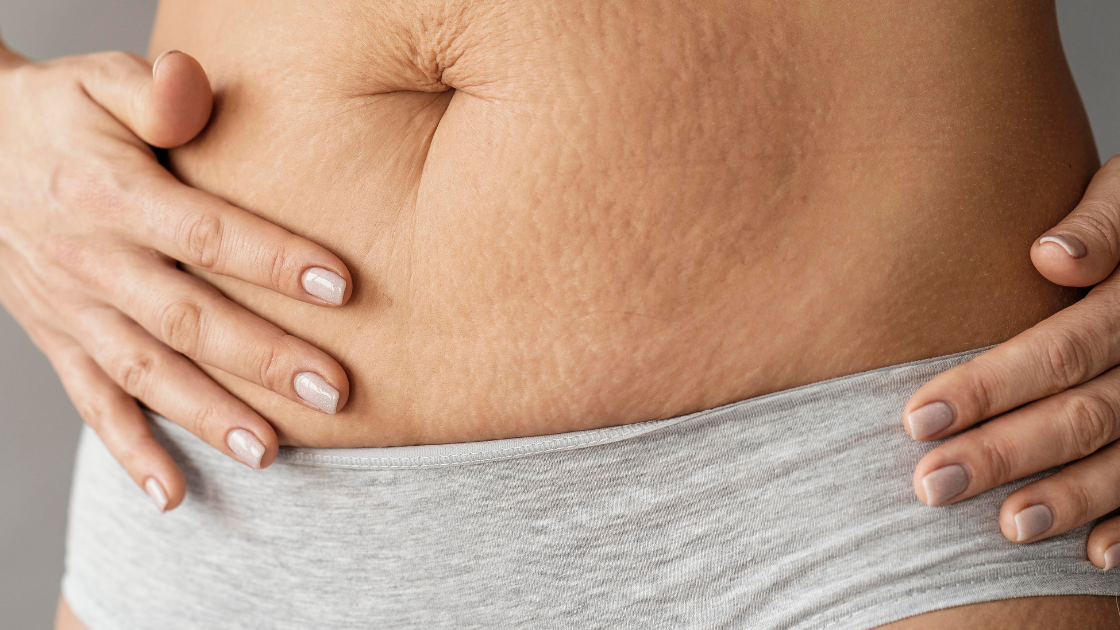 Worried About Pregnancy Stretch Marks? When to start using stretch