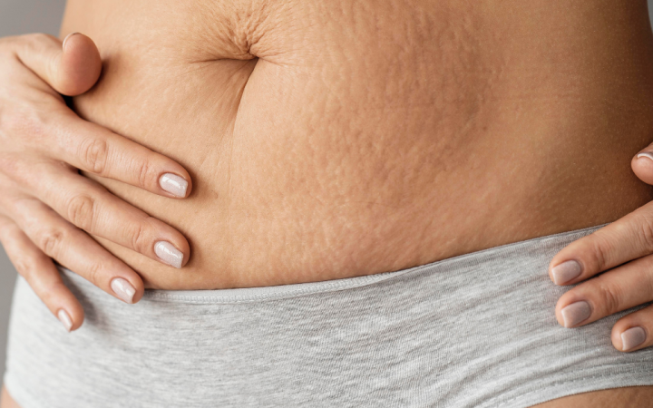 Post Pregnancy Stretch Marks - Matritva Care