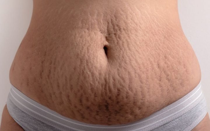 stretch marks post-pregnancy - Matritva Care